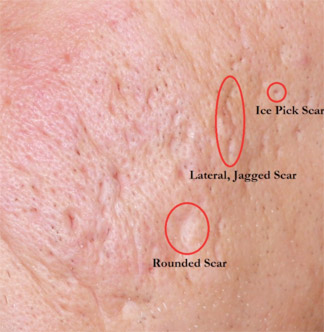 Example of acne scarring on cheek