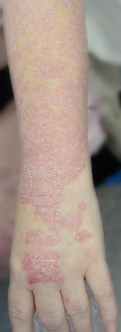 Example Arm Psoriasis