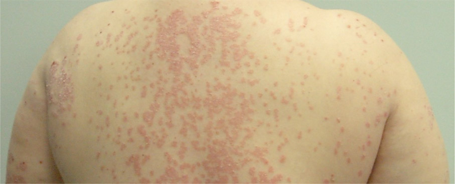 Example Back Psoriasis