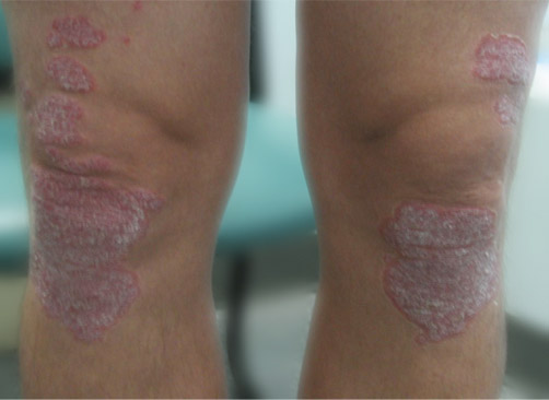 Example Knee Psoriasis
