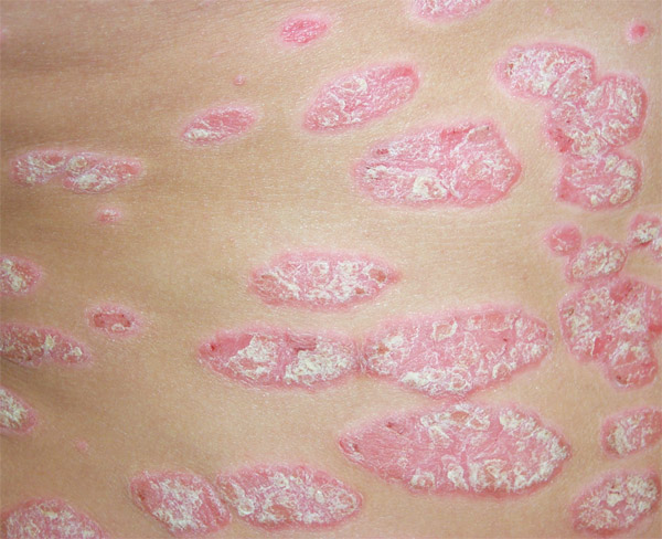 Example of Psoriasis