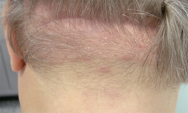 Example Scalp Psoriasis