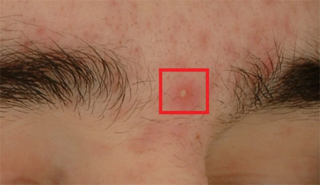 Example of a pustule