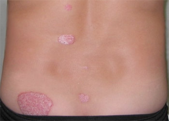 Example of Back Psoriasis