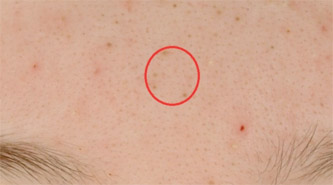 Example of blackheads