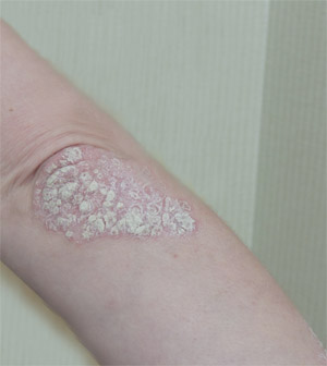 Example of Elbow Psoriasis