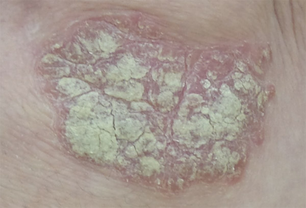 Example of Plaques of Psoriasis