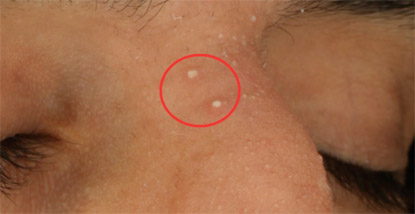 Example of pustules